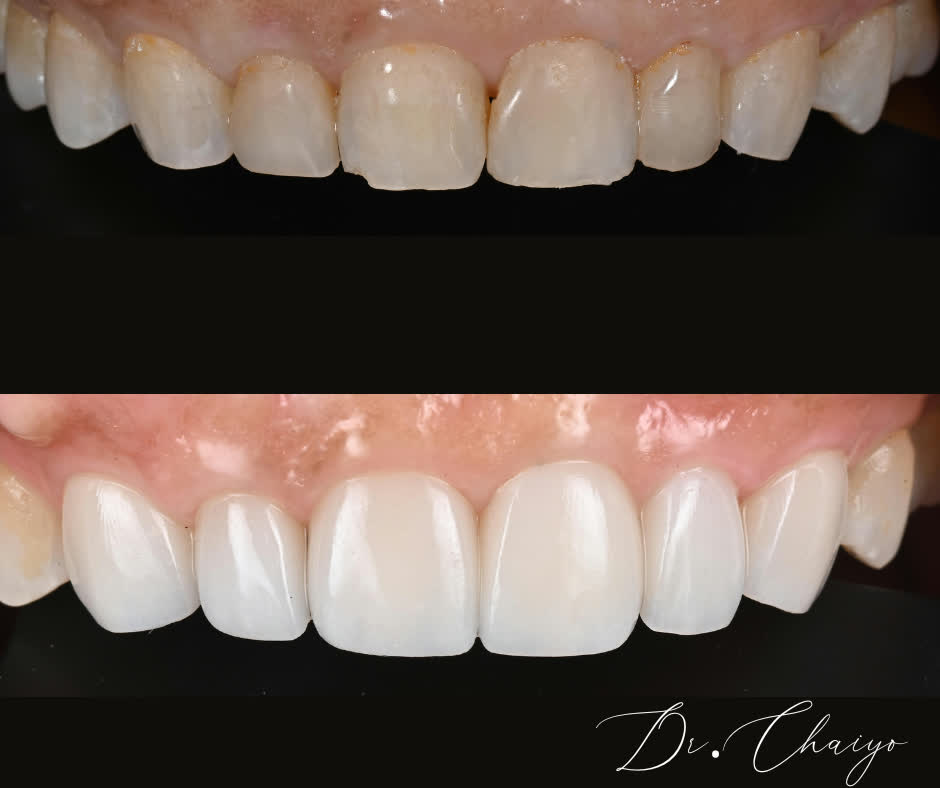 เคส before after ออกแบบรอยยิ้ม วีเนียร์ BY Dent ลำปาง