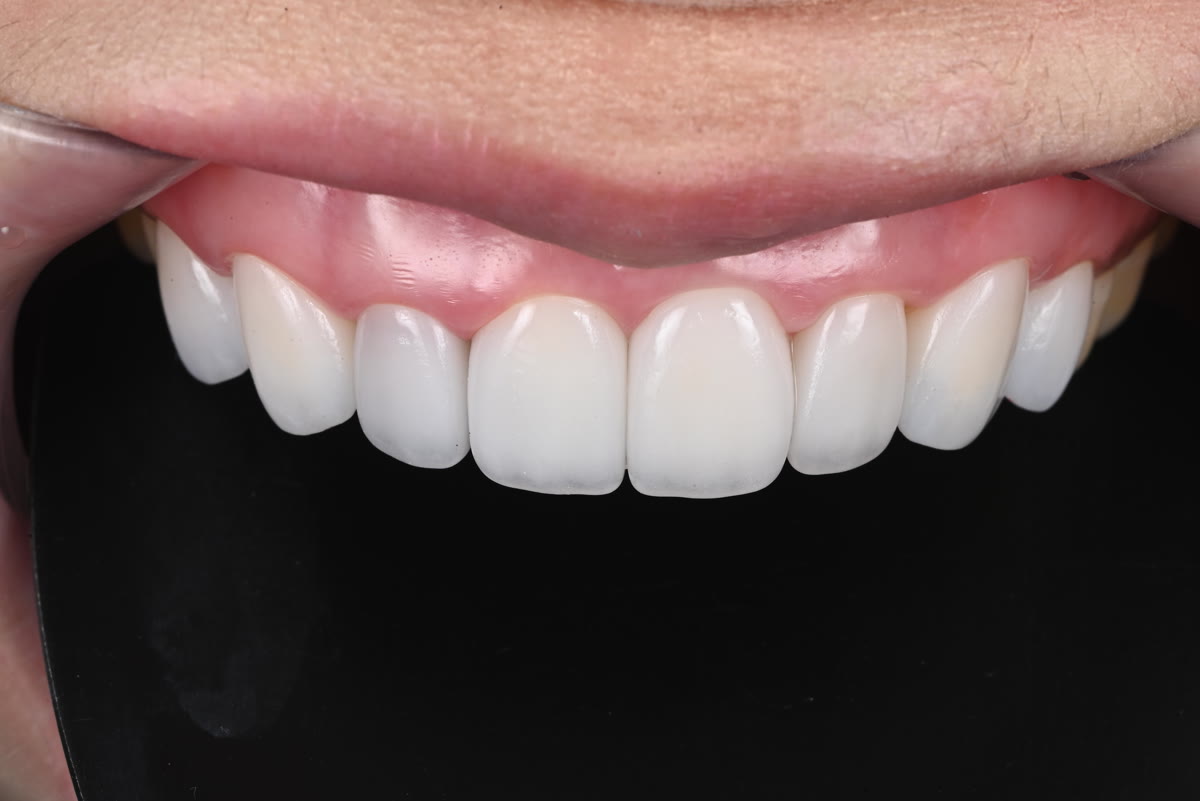 หลังทำเซรามิกวีเนียร์ฟันหน้า สีและทรงเป็นธรรมชาติ BY Dent ลำปาง