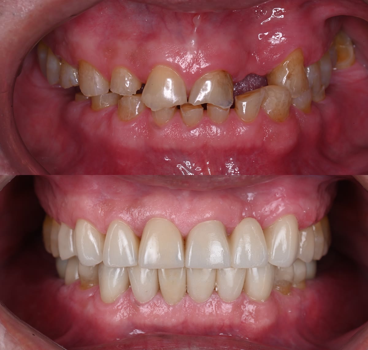 เคส before after บูรณะฟันทั้งปาก ครอบฟันเซรามิก BY Dent ลำปาง